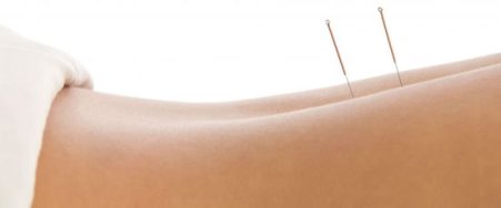 Dry Needling Bea Massage Therapy