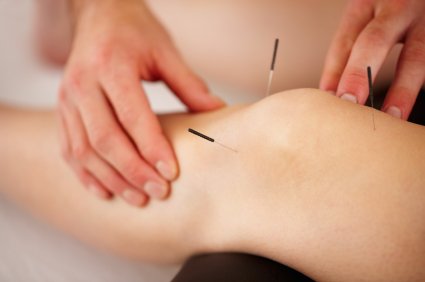 Dry Needling. Bea Massage Therapy.