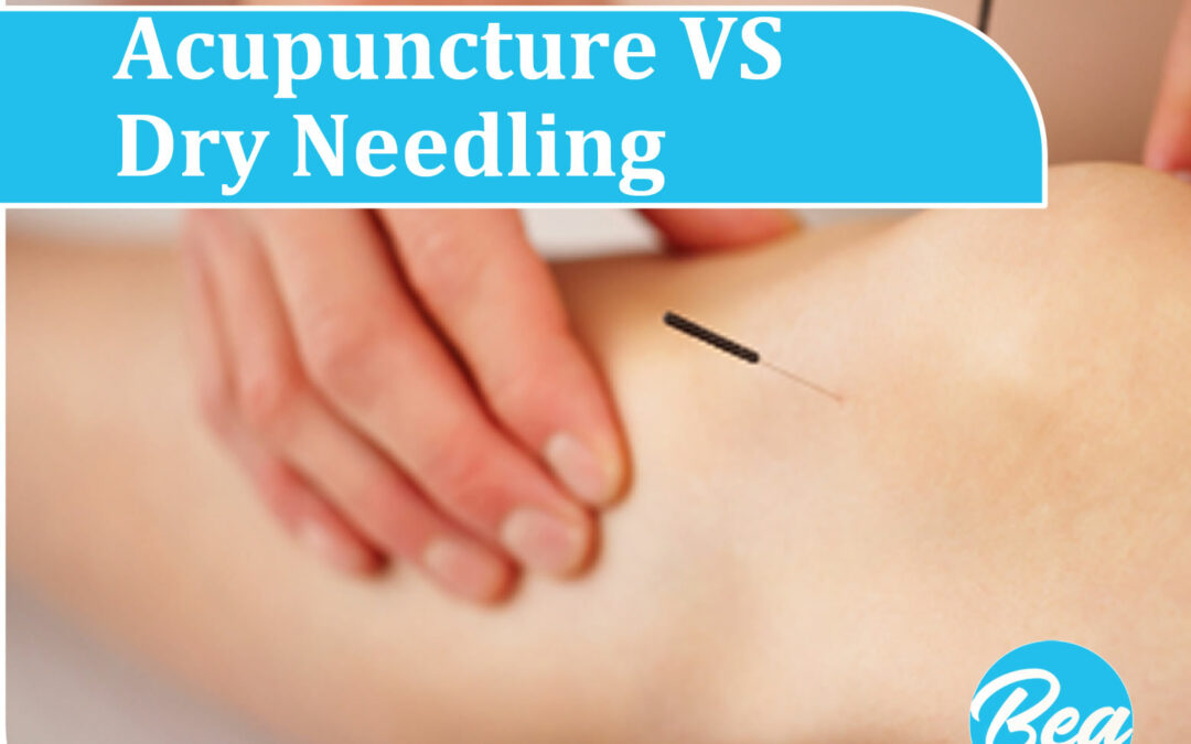 Acupuncture vs. Dry Needling